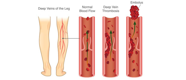 Deepveinthrombosis