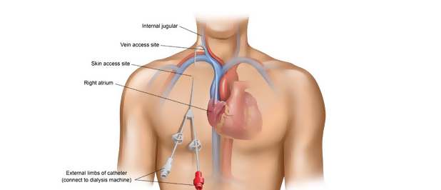 Hemodialysis Therapies