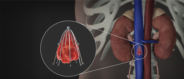 Inferiorvenacavafilter