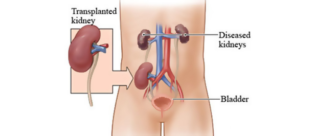 Kidney Transplantation