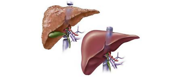 Liver Transplantation