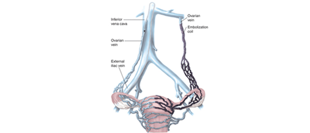 Treatment of pelvic congestion