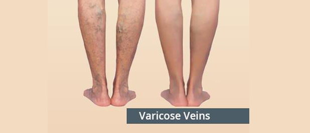 Varicose Vein Disease And Treatment