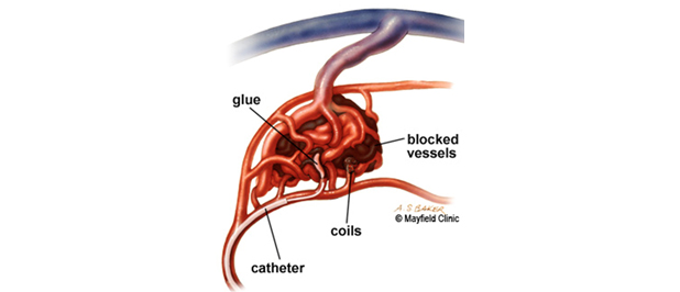 Vascular Malformations