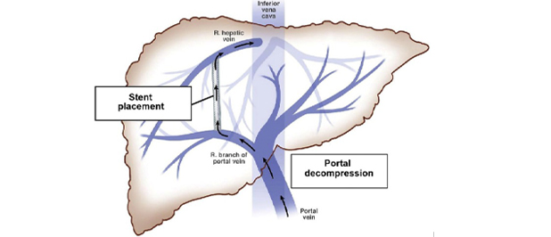 portal vein thrombosis