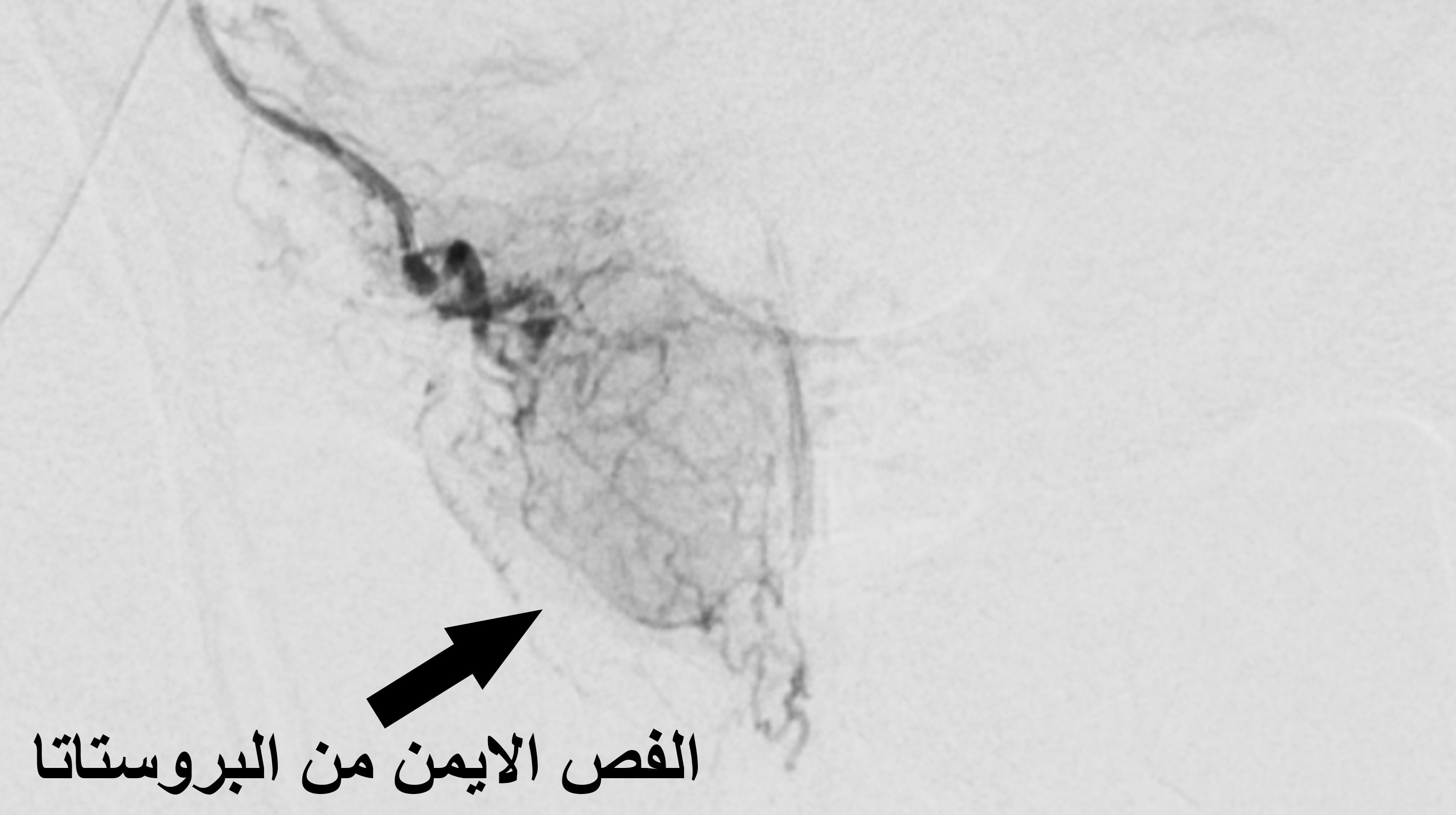 Prostatic Artery Embolization