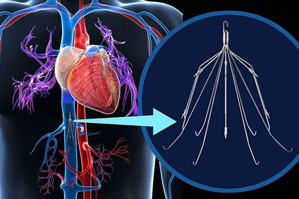 IVC Filter Placement - Dr. Mohamad Hosni